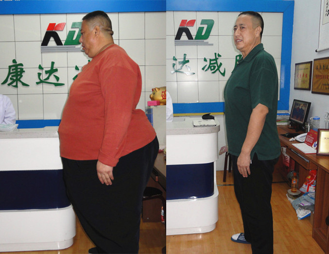 山东胖大叔小伙在长春康达医院共成功减掉455斤