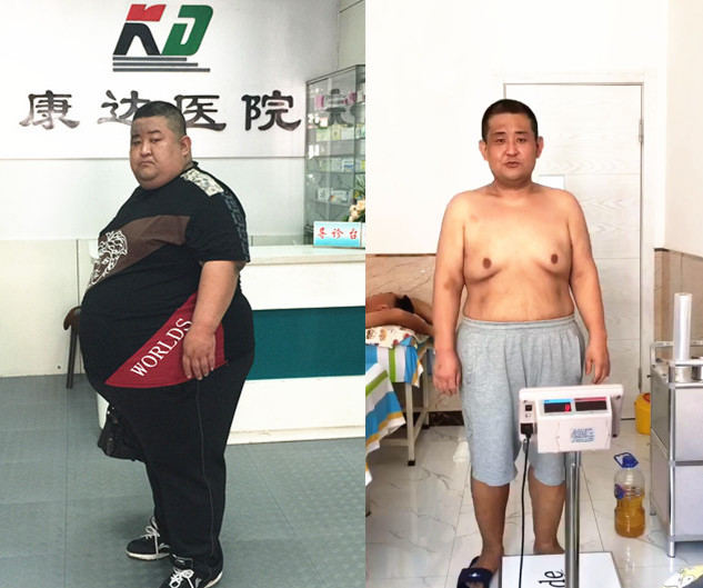 刘尚涛长春康达减肥一年瘦291斤