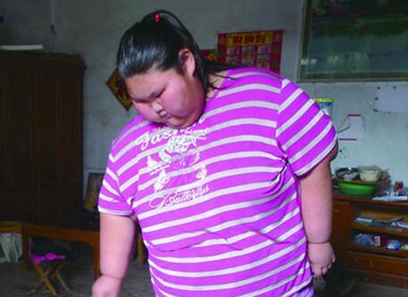 16岁少女330斤来吉林减肥已瘦134斤2