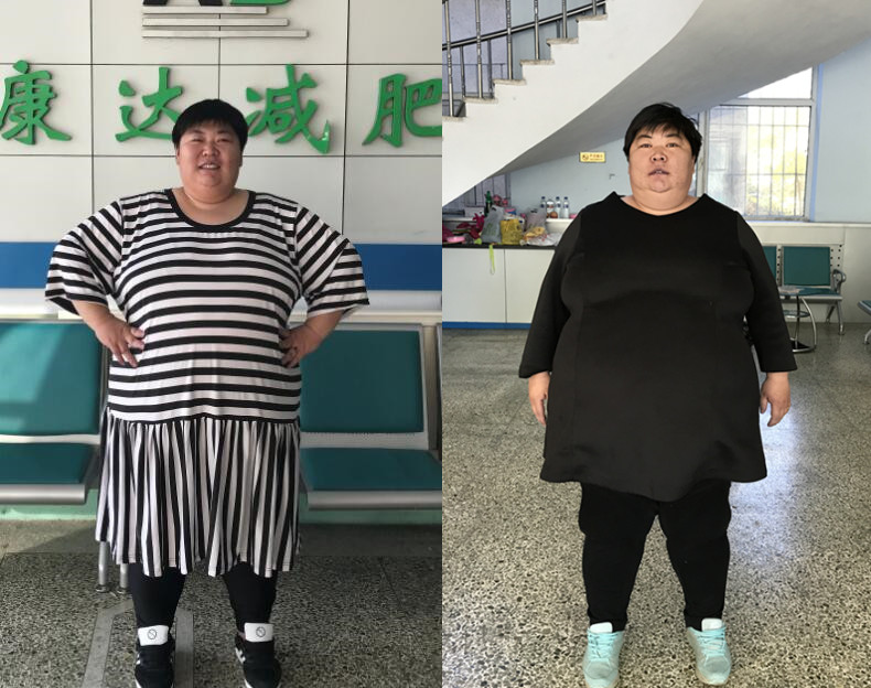 莱州孙晓萍到长春减肥 首月减64斤3