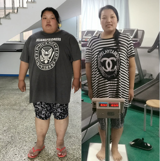 山东王丽丽在康达减肥155斤2