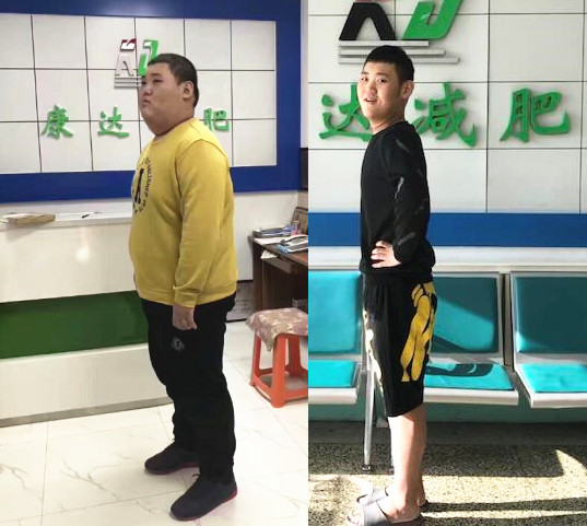 辽宁重300余斤男孩在长春减肥139斤1