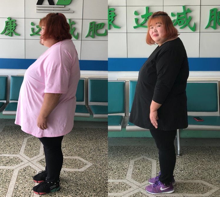 江苏胖妹到长春减肥,一个月瘦40斤5