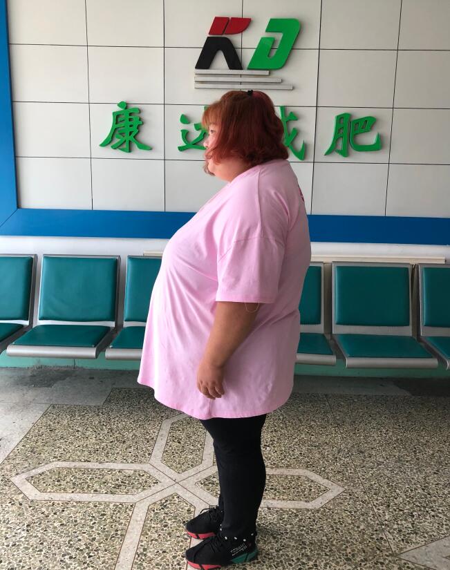 在长春康达减肥治疗190天,张玉娜甩肉145斤2