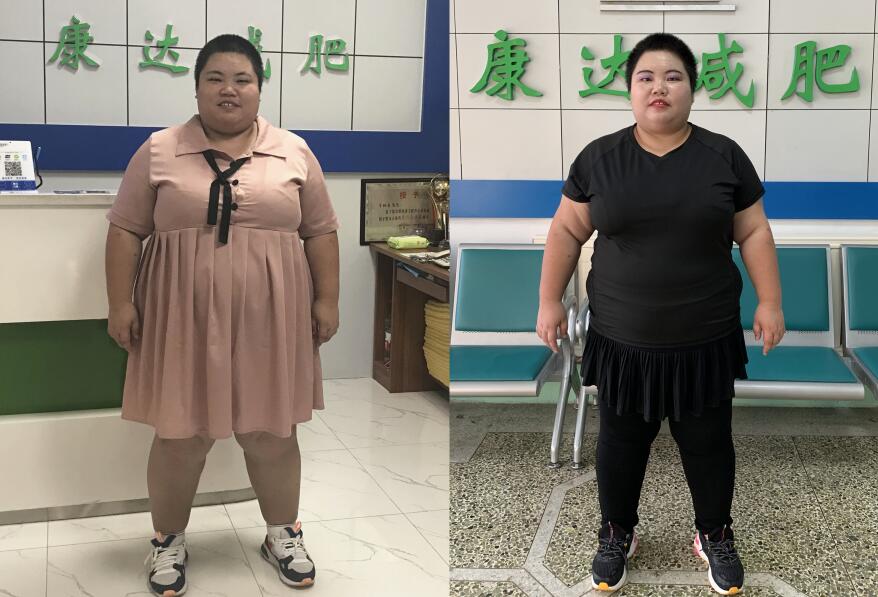 300斤陈前芳长春减肥,首月减近40斤4