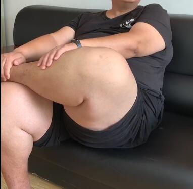 吉林减肥专家提醒:隐形肥胖最凶险