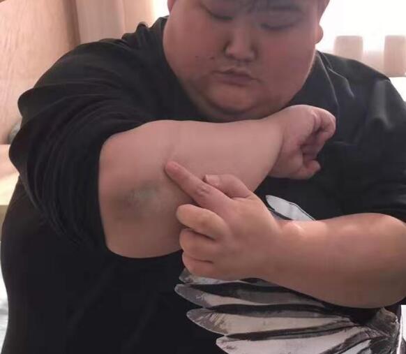 肥胖易诱发这几种慢性疾病