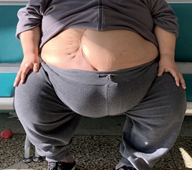 英国研究称肥胖或增加新冠病毒致死风险
