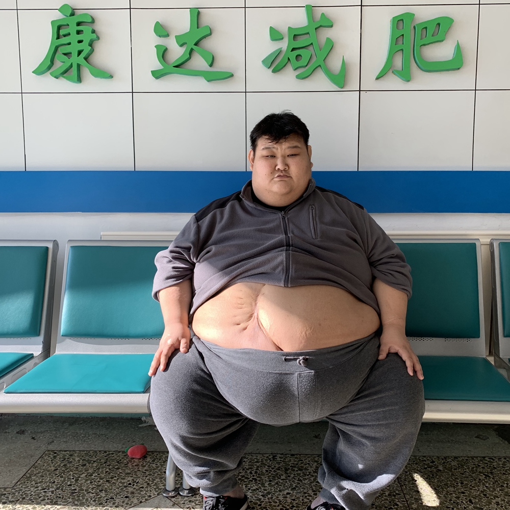 巨胖小哥儿在长春康达减肥医院狂减122斤1