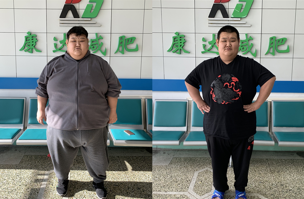 巨胖小哥儿在长春康达减肥医院狂减122斤5